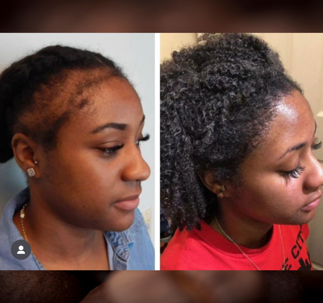 Batana Oil 2oz |Dr.Sebi Approved Hair growth Miracle Oil For Alopecia|