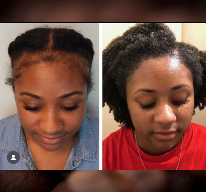 Batana Oil 2oz |Dr.Sebi Approved Hair growth Miracle Oil For Alopecia|