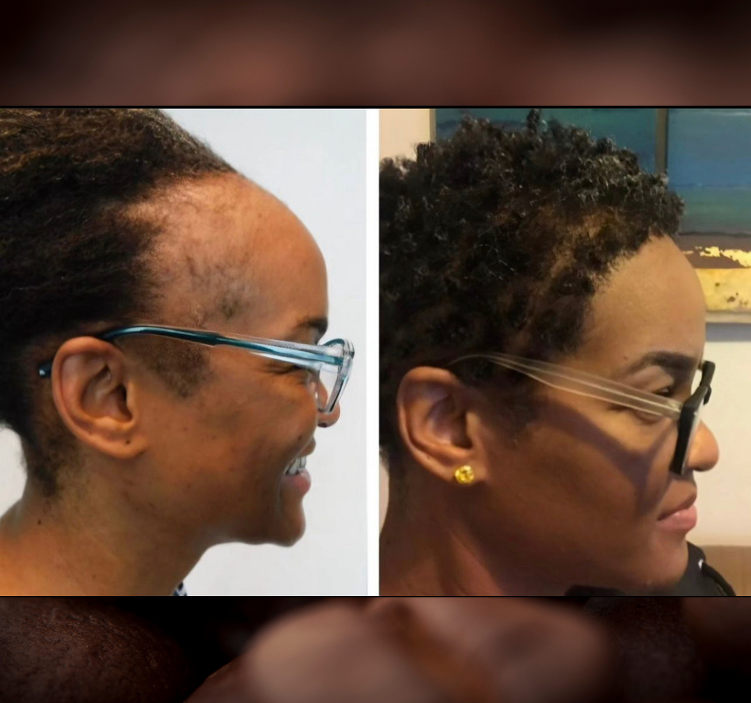 Batana Oil 2oz |Dr.Sebi Approved Hair growth Miracle Oil For Alopecia|